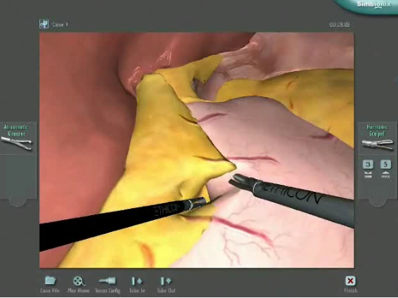Creating the Gastric Pouch Video