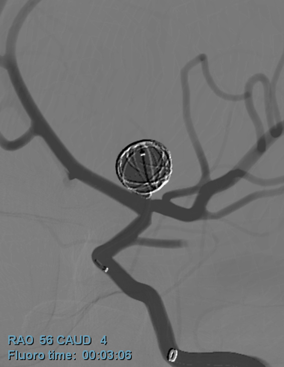 L-ICA Aneurysm Coiling