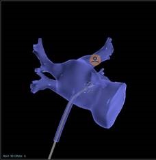 Mapping Catheter