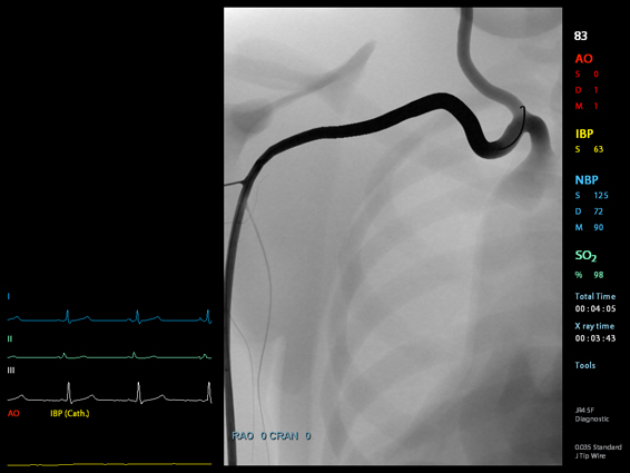 Tortuous Subclavian