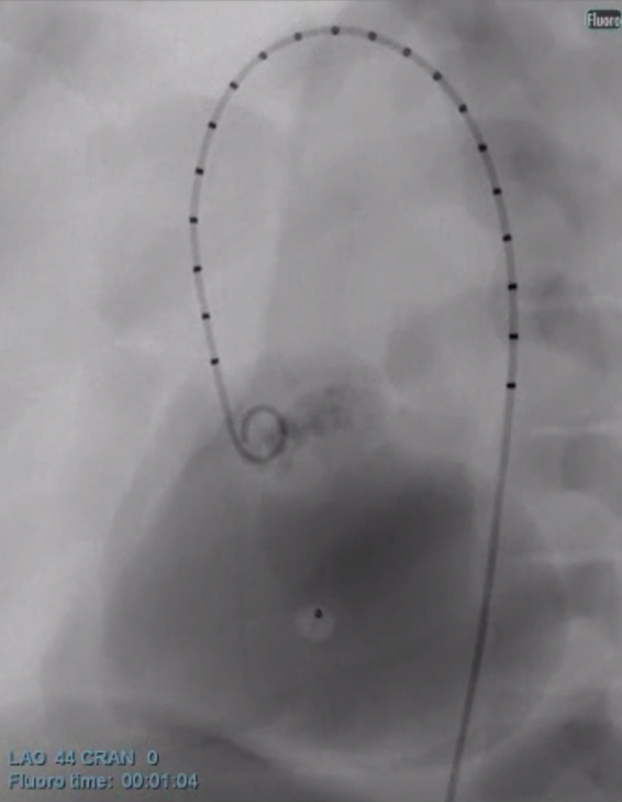 Video - Aortic Valve Replacement