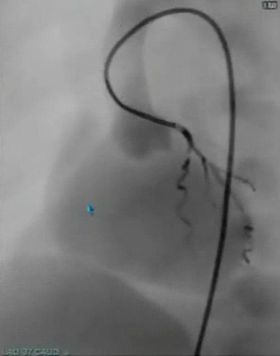 Video - Coronary Angioplasty Stenting