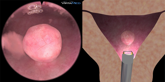 Realistic Simulation of Hysteroscopic Instruments