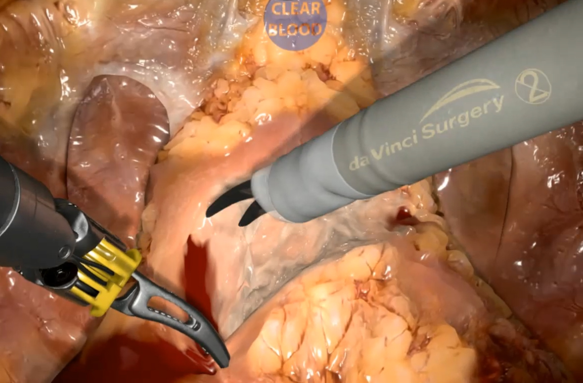 Video - Prostatectomy - Bladder Neck Dissection