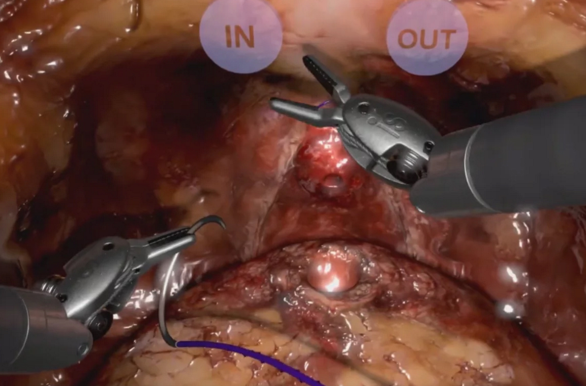 Video - Robotic Radical Prostatectomy-Guided Anastomosis