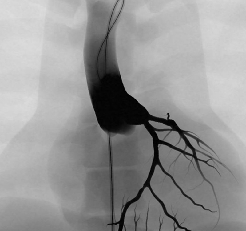 Angiogram of lesion_Case 1