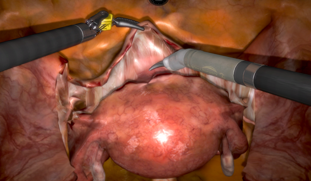 Robotic Surgery for Hysterectomy