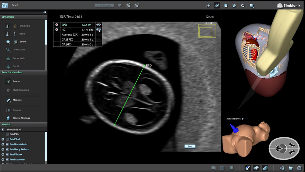 Video - OB 2nd - trimester Fetal Biometry