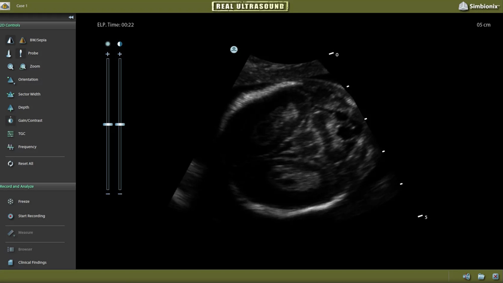 Video - Fetal Neurosonography