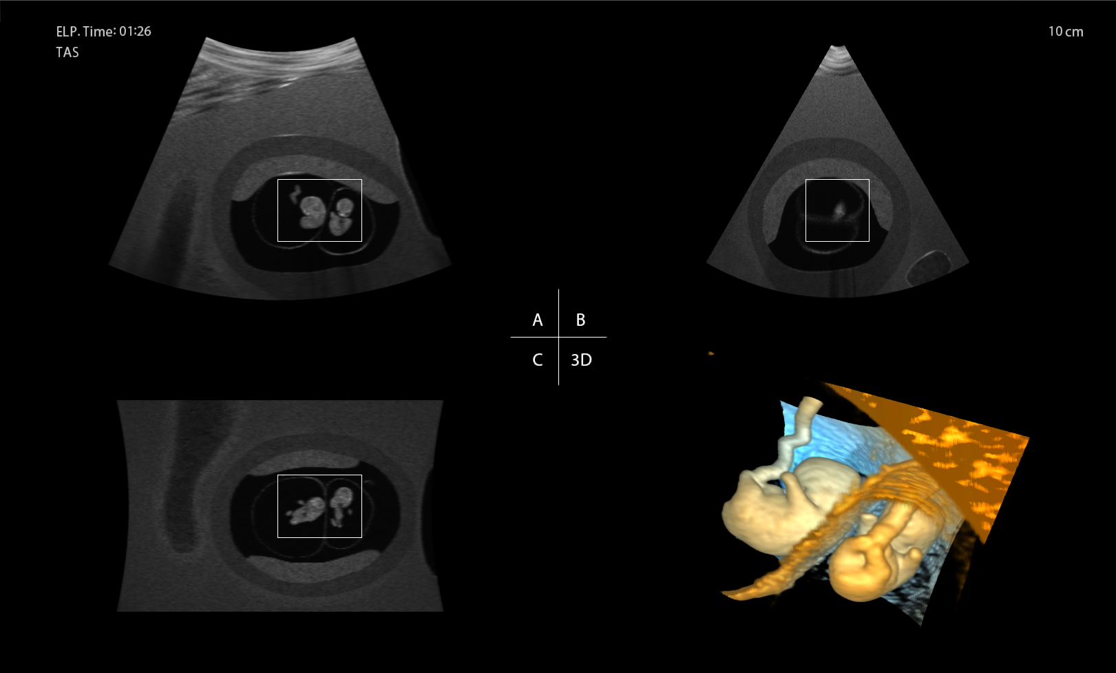 3D Ultrasound - MCDA