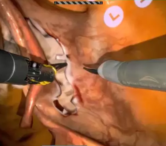 Video - FRGS Curriculum on the da Vinci Xi – Ureter Identification and Dissection