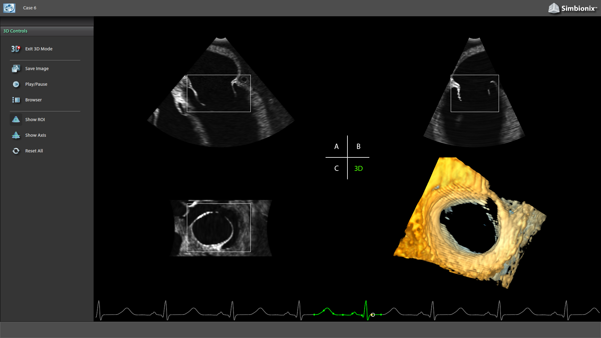 The new 3D mode – enables to review and navigate throughout the cardiac cycle