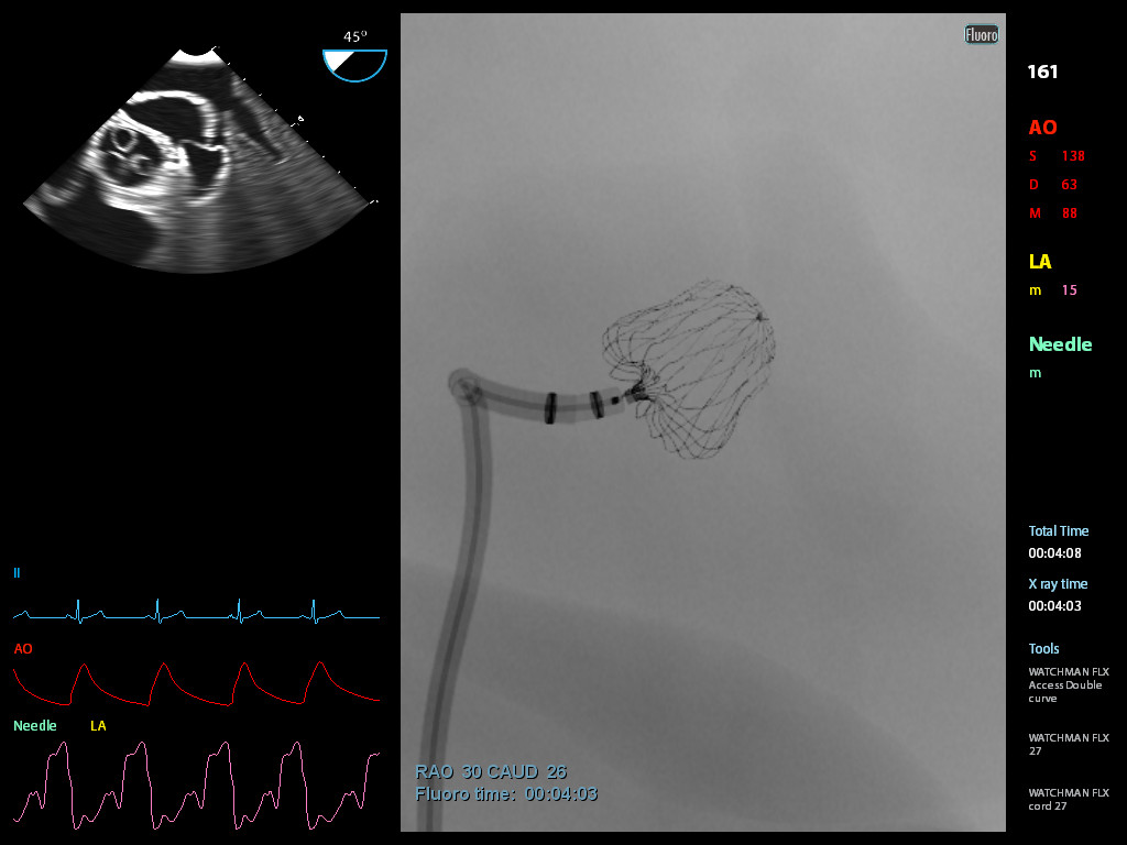 Occlusion Device in the LAA 