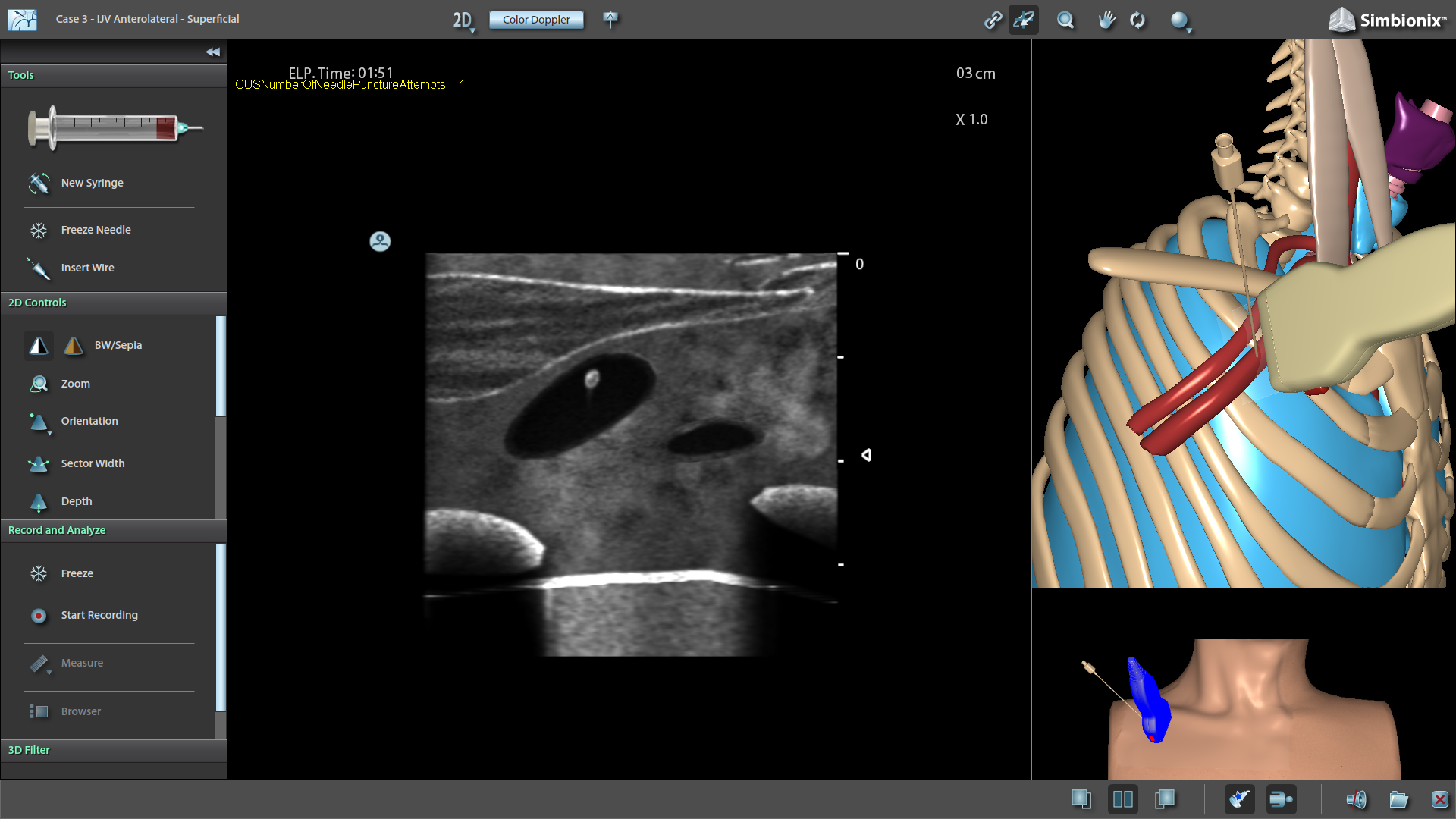 Ultrasound-guided Subclavian Vein Access