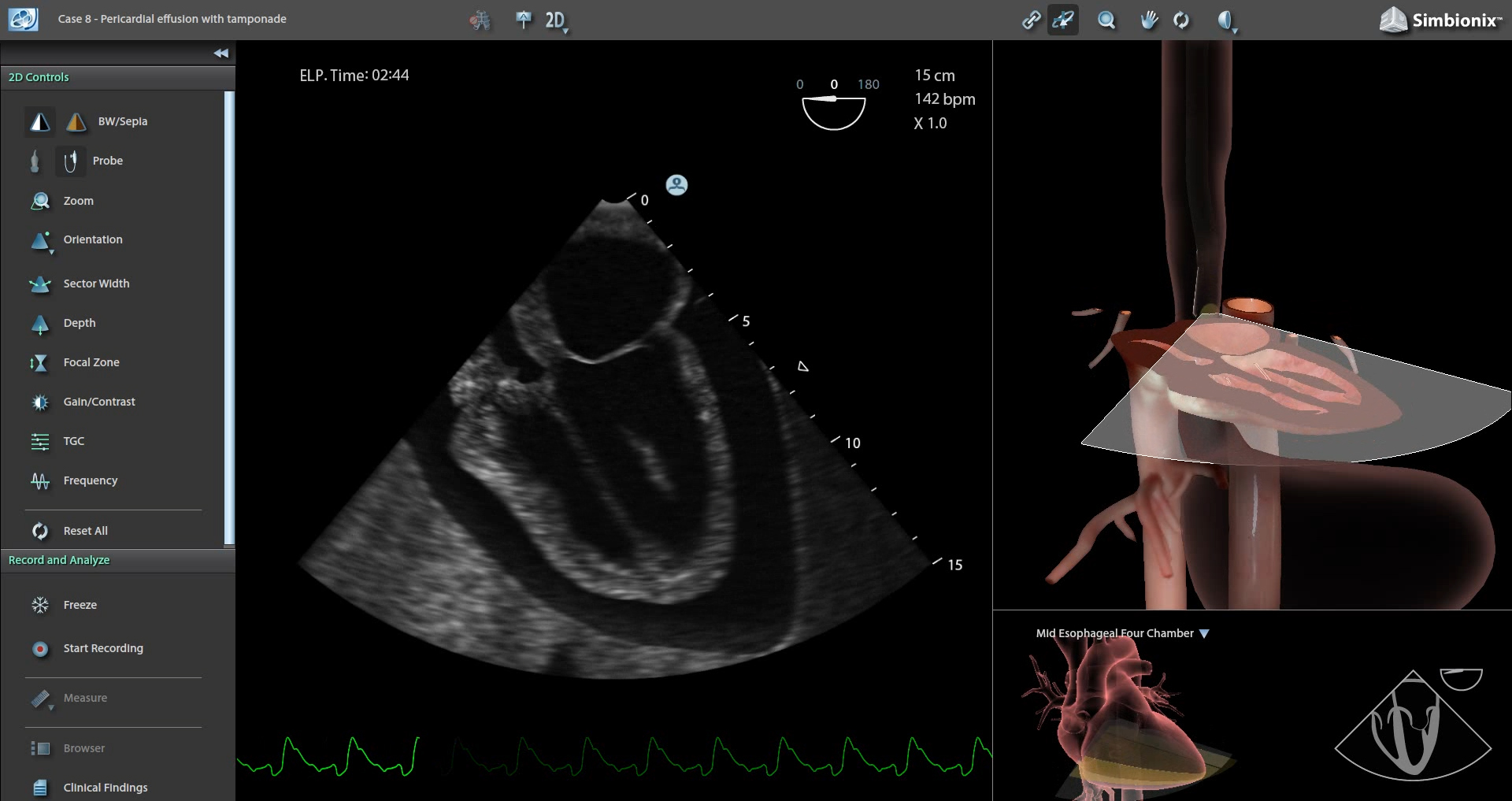Video- Pericardial Effusion with Temponade
