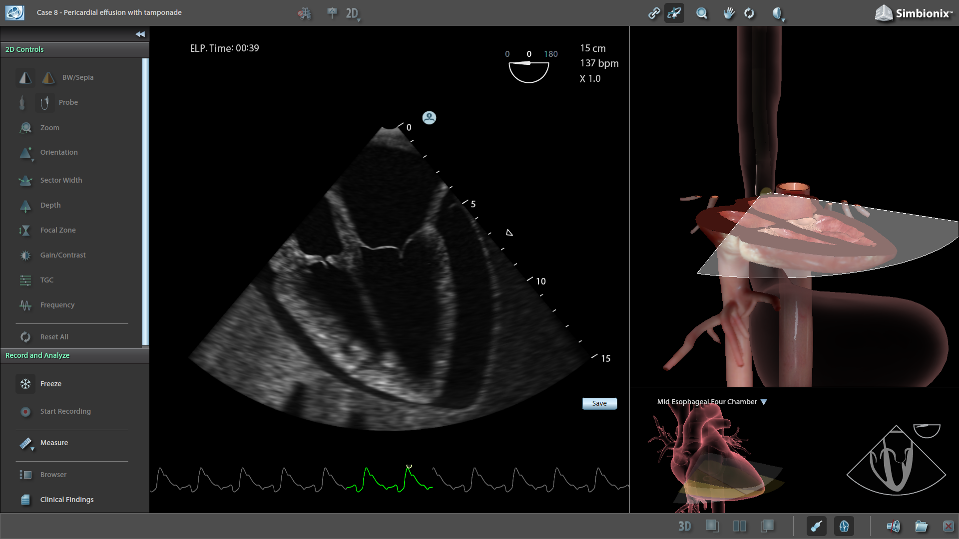 Pericardial effusion with Temponade